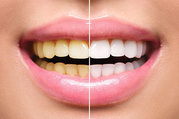 9 причин, почему желтеют зубы